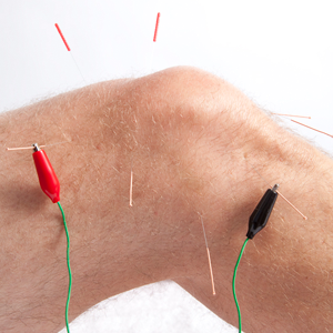 What Conditions Does Acupuncture Treat?
