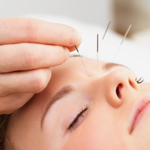 What Are the Benefits of Acupuncture Treatment?